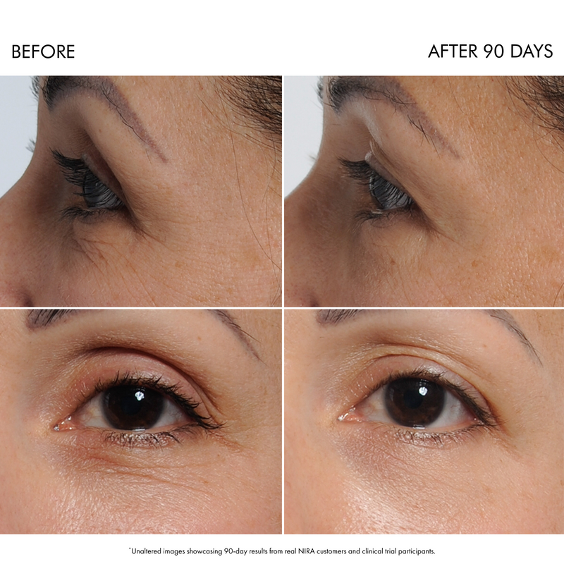 Load image into Gallery viewer, NIRA Precision Laser & Skincare Bundle