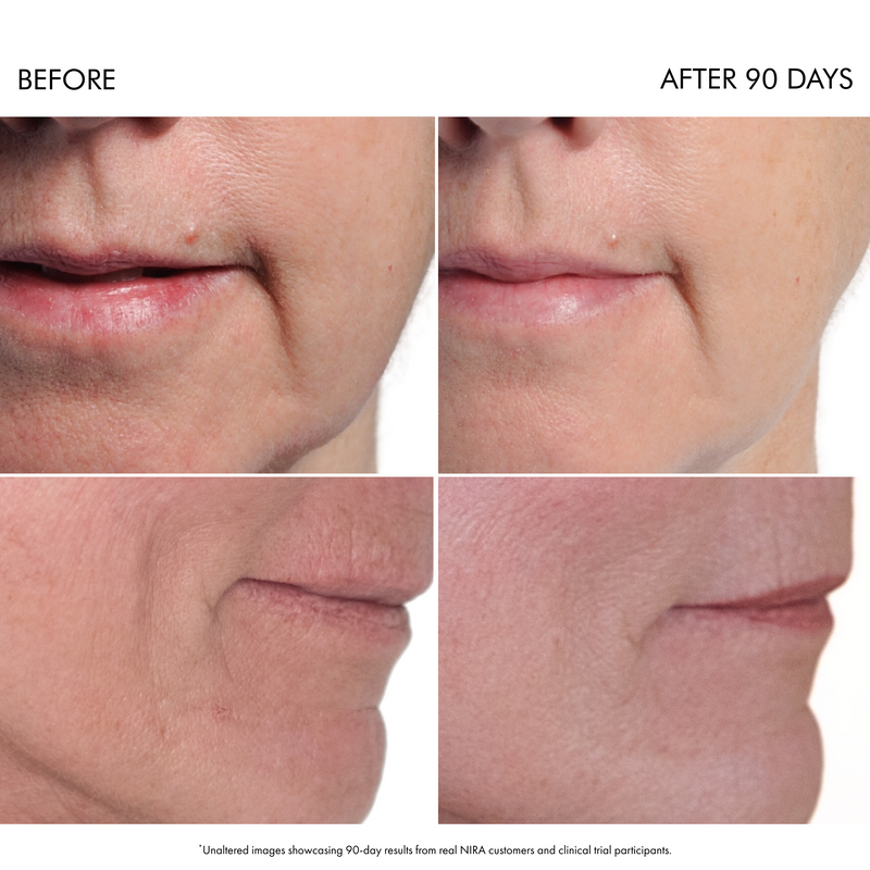 Load image into Gallery viewer, NIRA Precision Laser & Skincare Bundle
