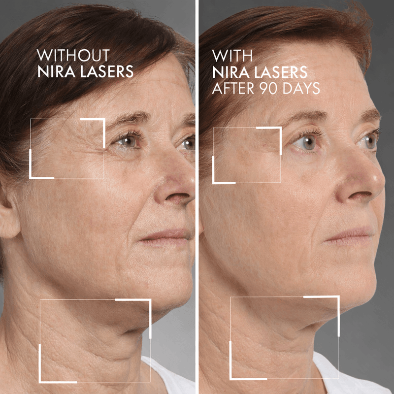 Load image into Gallery viewer, NIRA Pro 3 Laser & Skincare Bundle