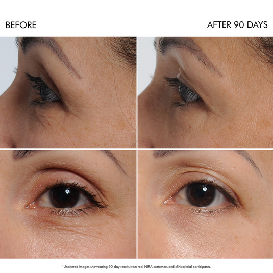 NIRA Precision Laser & Skincare Bundle