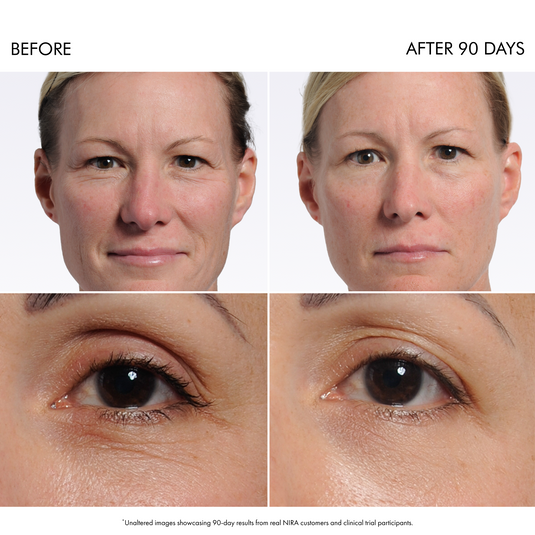 NIRA Pro 3 Laser & Skincare Bundle